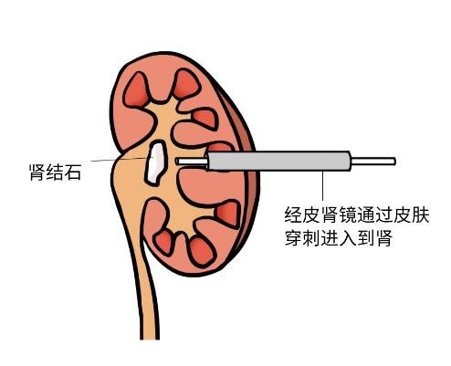 科隆肾研究最新进展与应用动态